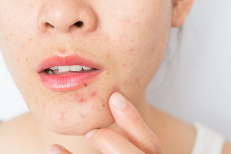 Foods To Avoid During Hormonal Acne