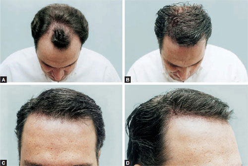 PREOPERATIVE PREPARATION FOR A HAIR TRANSPLANT