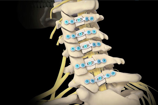 Understanding Laminectomy Spine Surgery: A Comprehensive Guide to Spinal Decompression