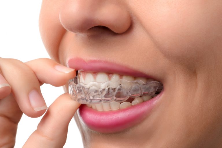 Transform Your Smile: Jaw-Dropping Invisalign Before and After Results