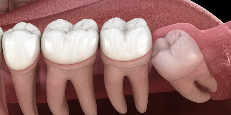 Tooth Impaction: Causes, Symptoms, Treatment
