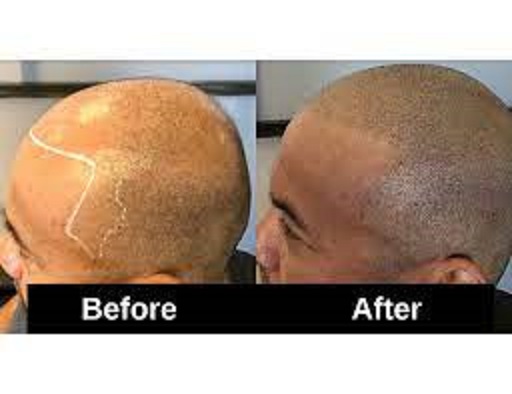 Scalp Micropigmentation (SMP) as an Alternative to Hair Transplants