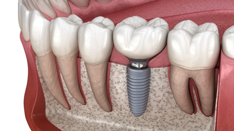 Introduction of Dental Implants for a Glistening Smile and Top 10 Features!