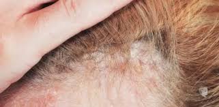 Natural Side Effects of Nanoplastia Hair Treatment