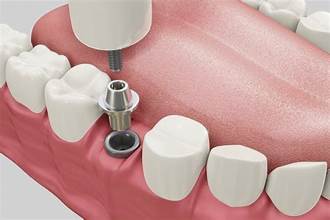 The Benefits of Choosing Dental Implants Los Angeles