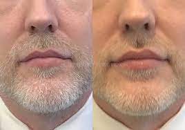 How Lip Flip Treatment Can Help To Get The Best Shape Of The Upper Lips In Scottsdale?