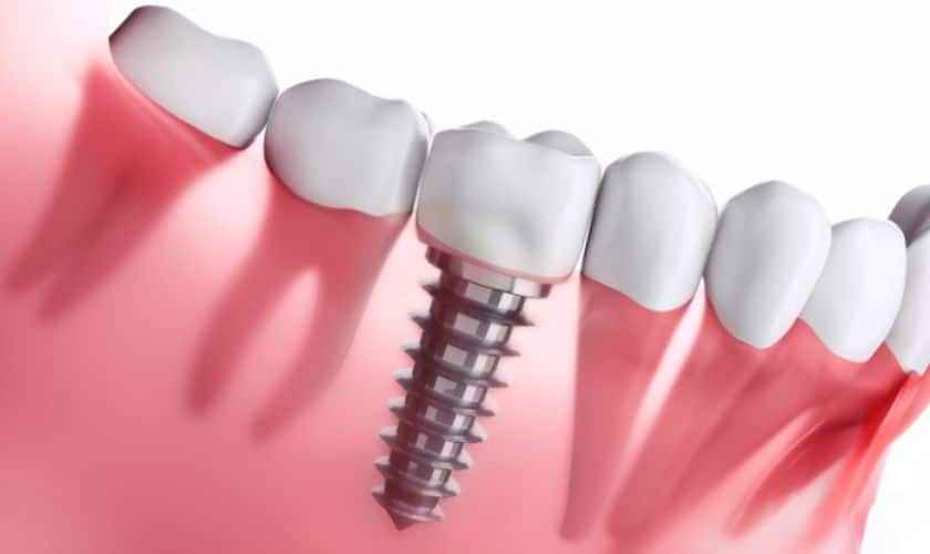 The Future of Dental Implants: Innovations and Emerging Technologies