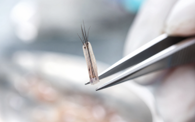 How To Compare FUE And FUT Hair Transplants Before Choosing A Treatment Plan
