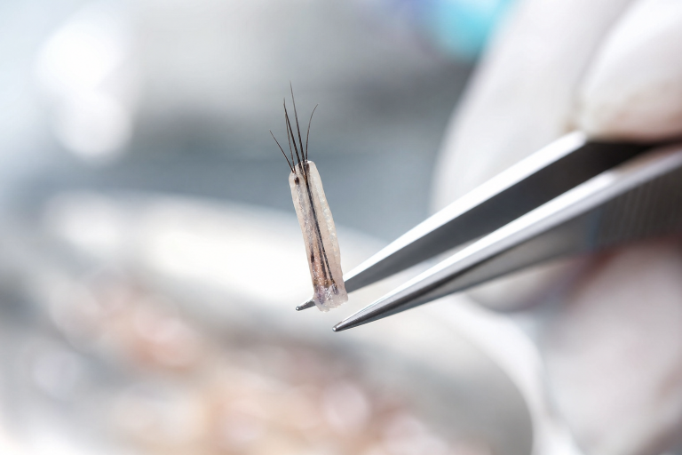 How To Compare FUE And FUT Hair Transplants Before Choosing A Treatment Plan